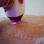 Laserowe usuwanie rozstęp&oacute;w